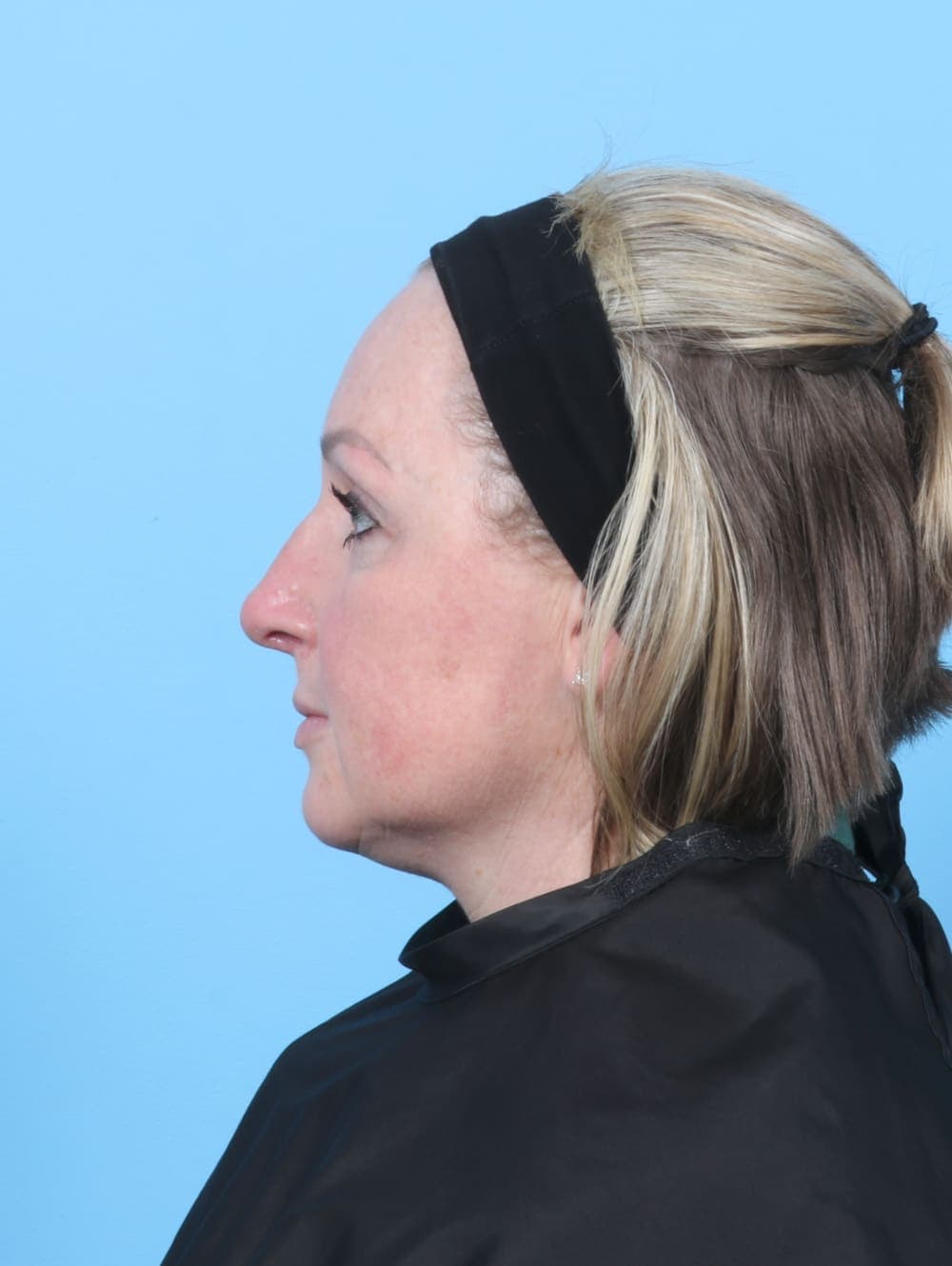 Facial Surgery case #6205 after