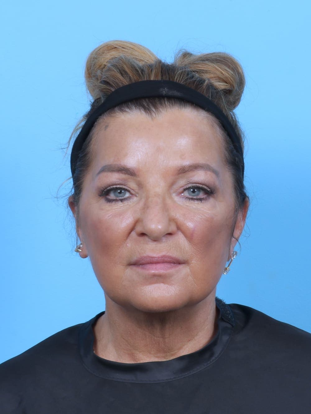 Eyelid Surgery case #5739 after