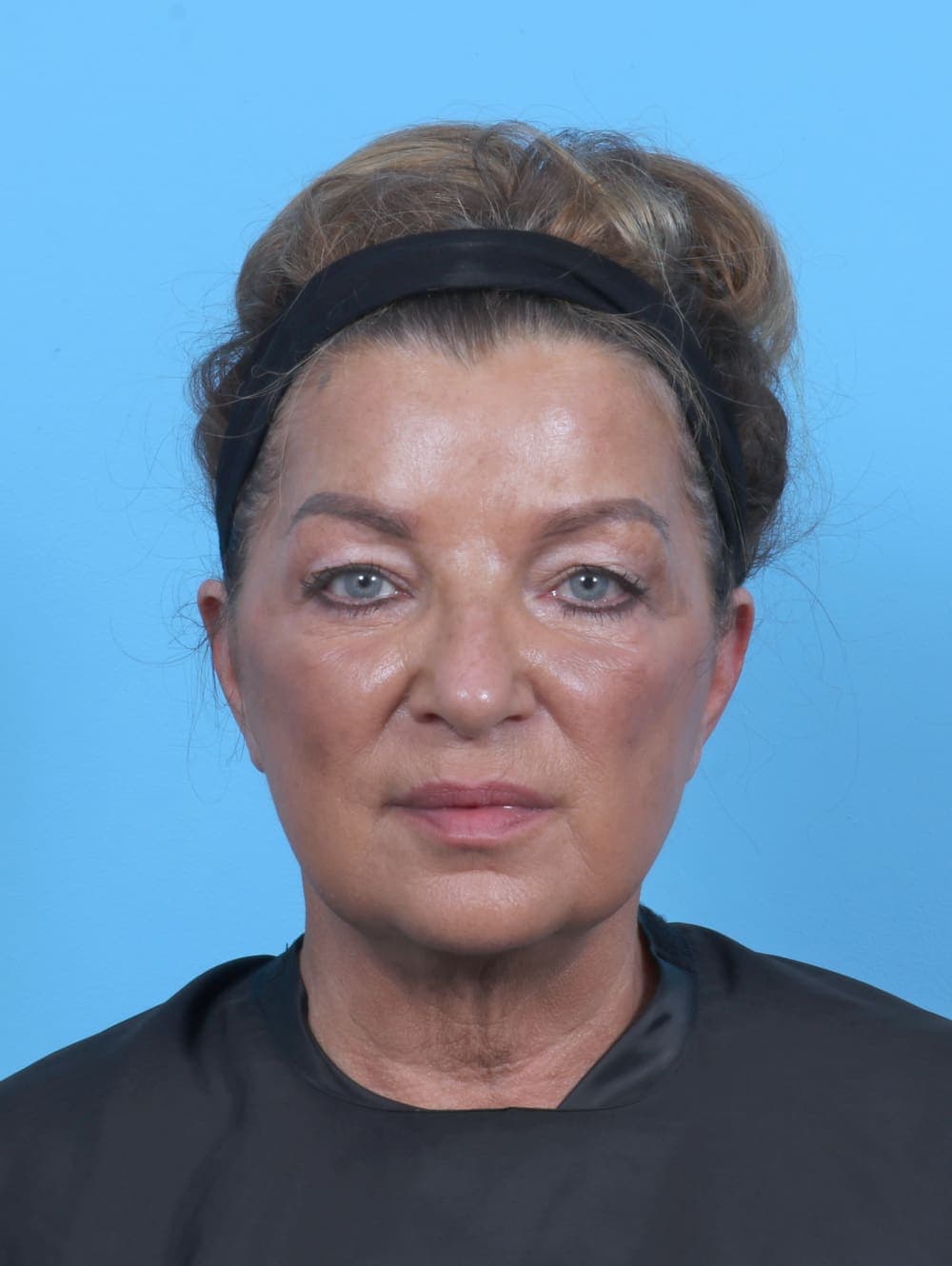 Eyelid Surgery case #5739 before