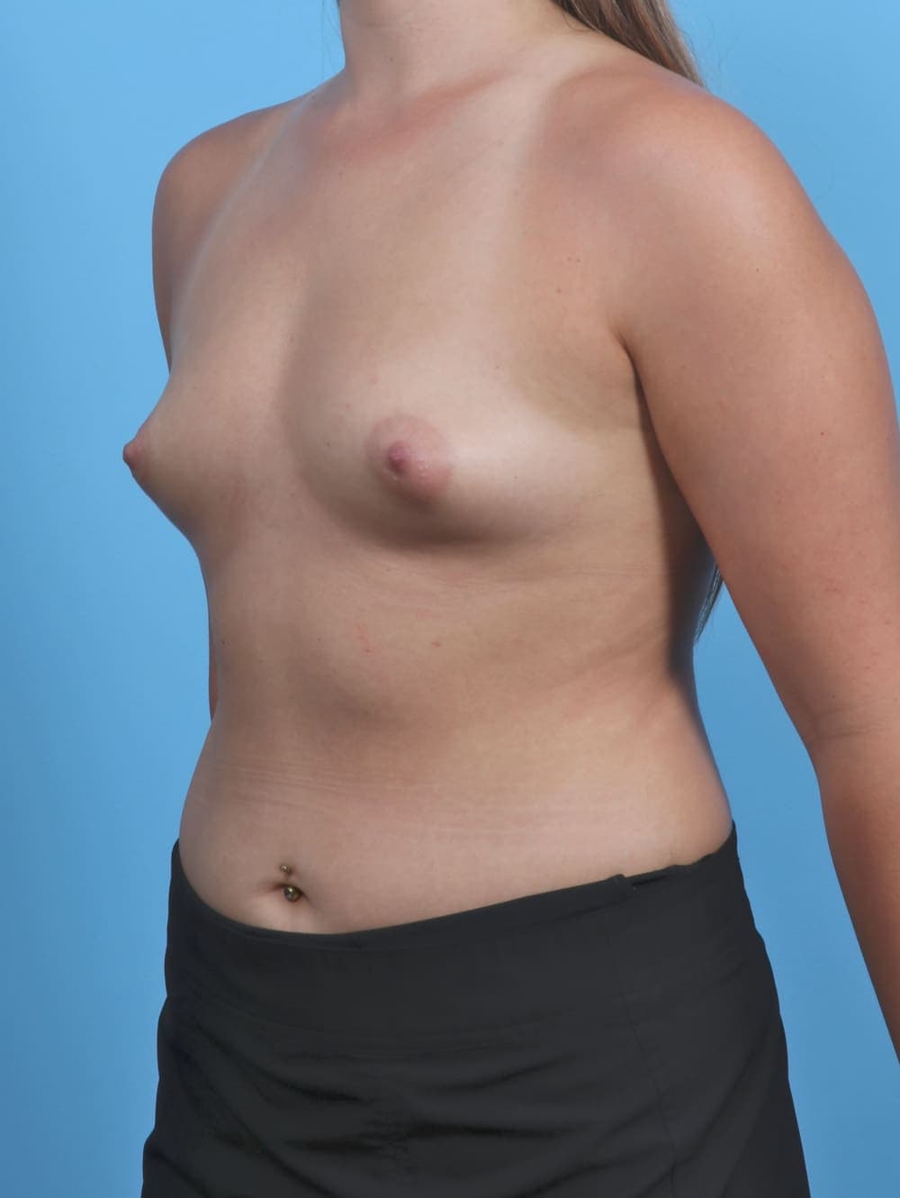 Breast Augmentation case #4934 before, image 2
