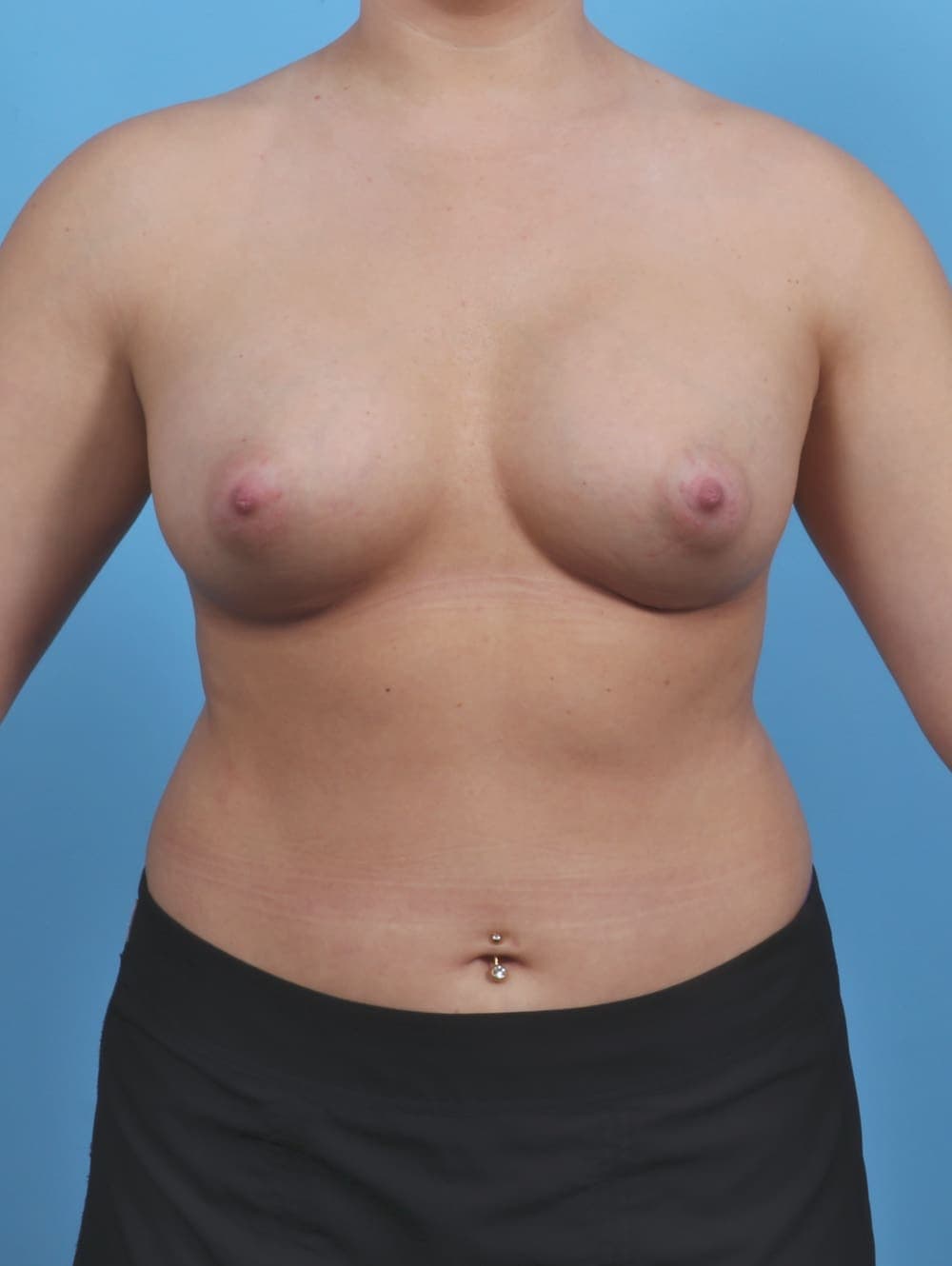 Breast Augmentation case #4934 after