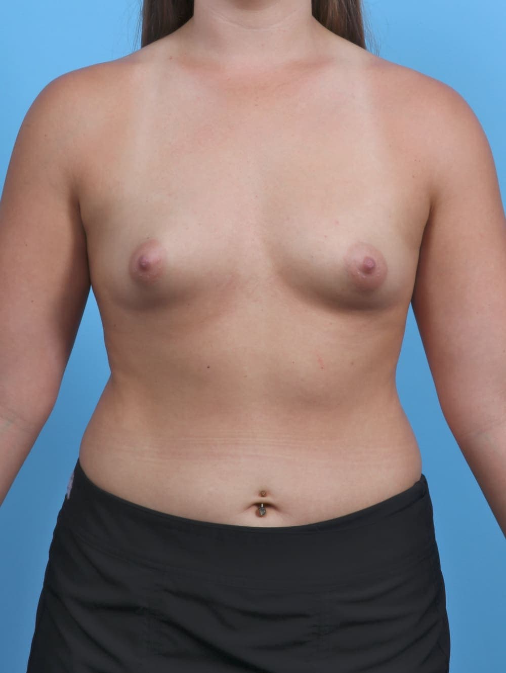 Breast Augmentation case #4934 before