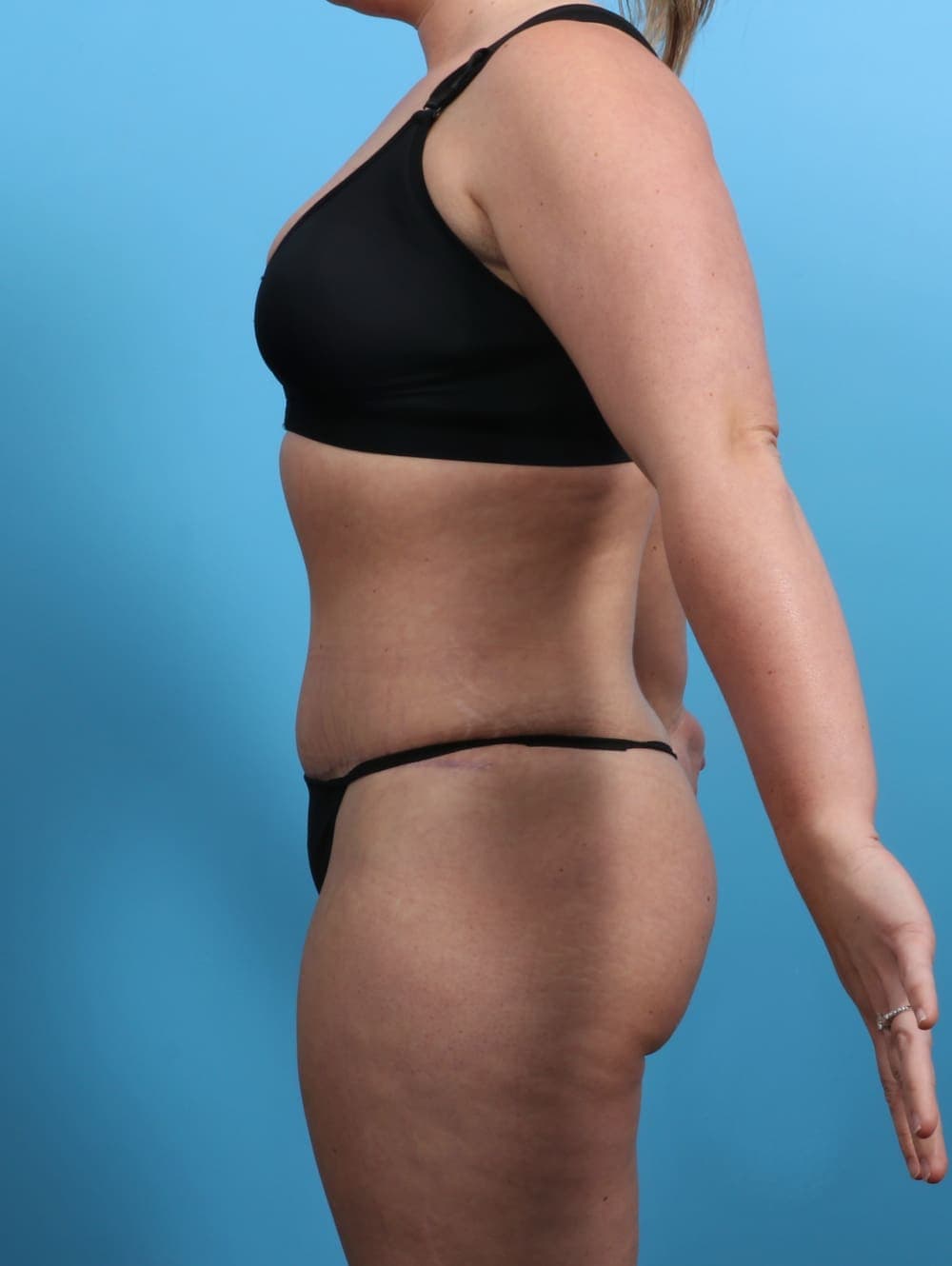 Tummy Tuck case #3510 after, image 3