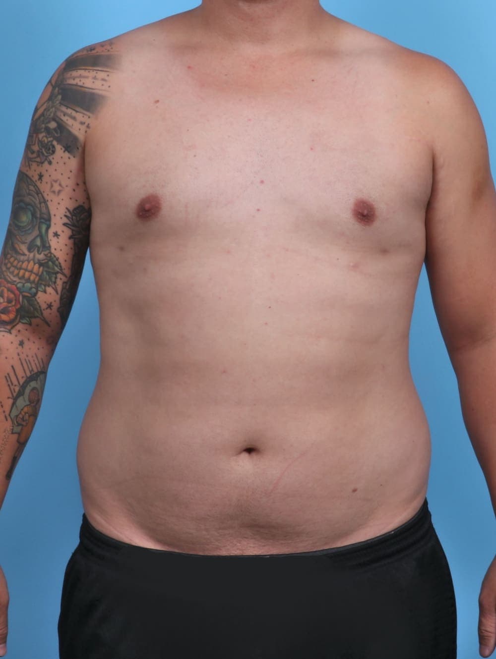 Male Breast Reduction case #3763 after, image 1
