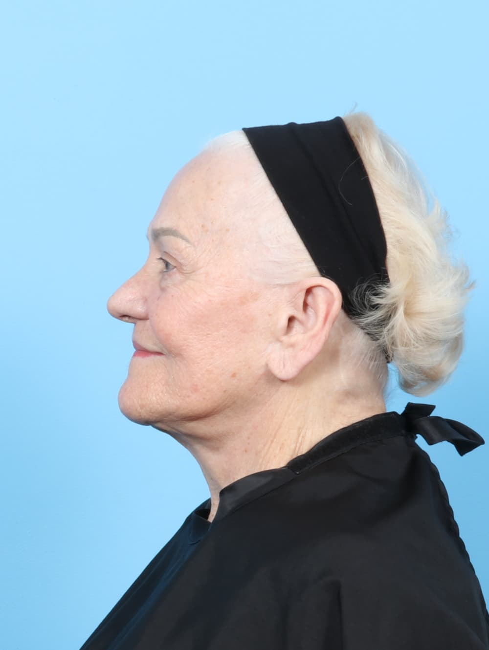Facelift case #8177 before, image 4