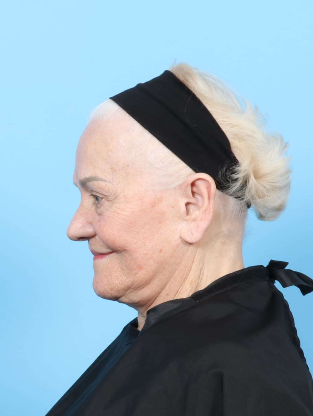 Facelift case #8177 before, image 2