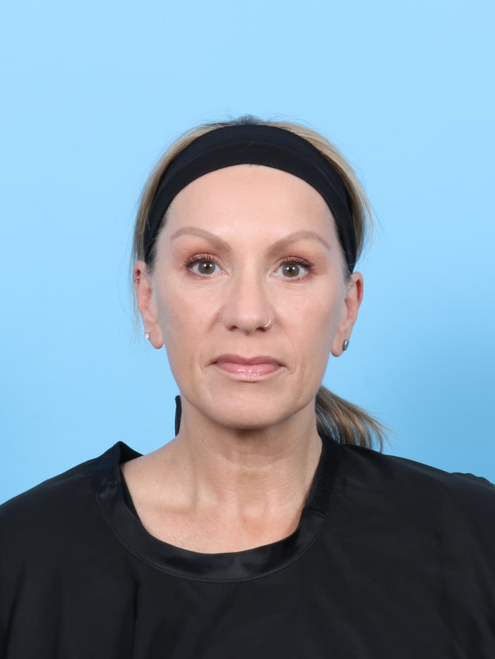 Facial Surgery case #7331 after