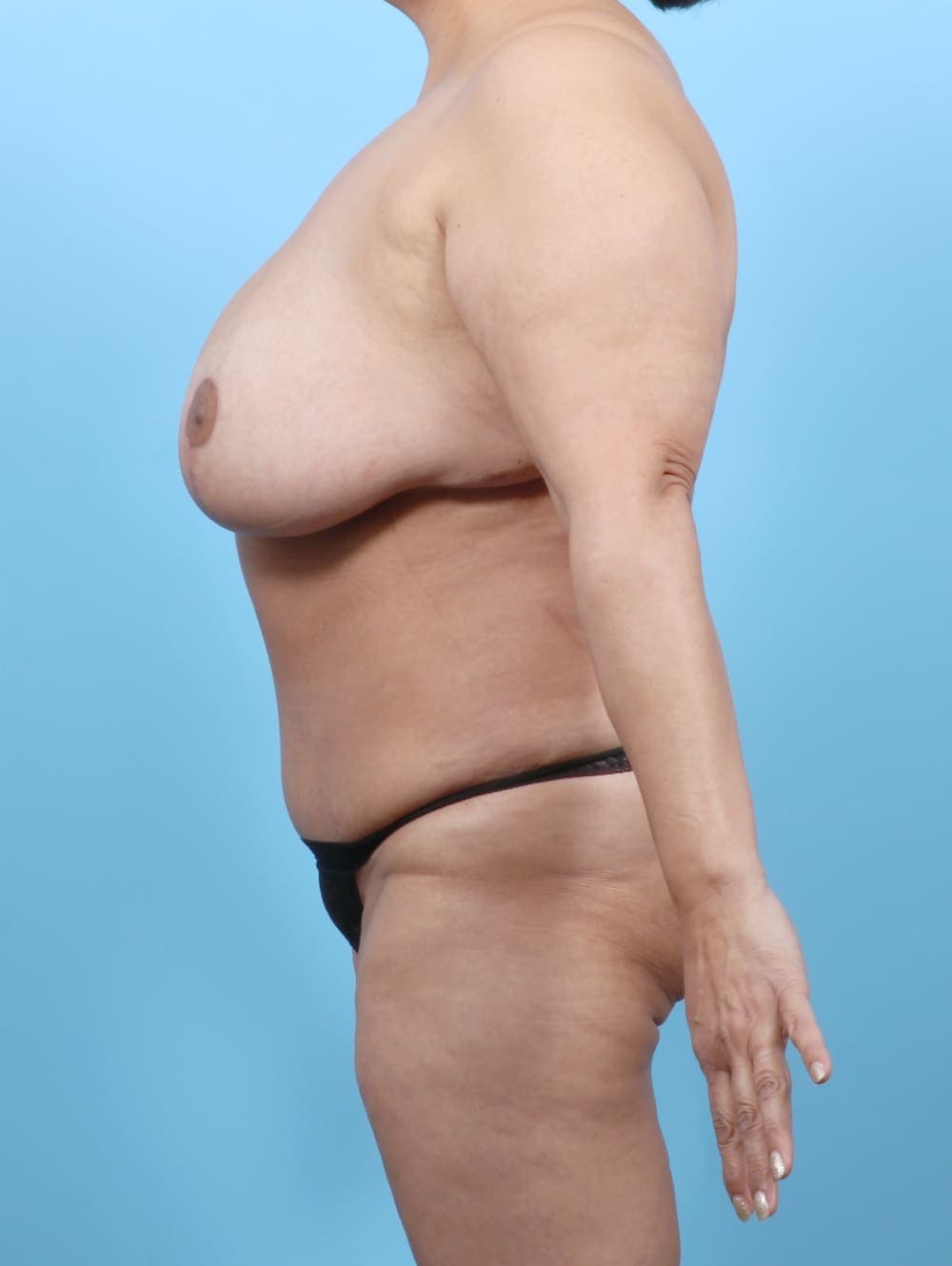 Tummy Tuck case #6459 after, image 4