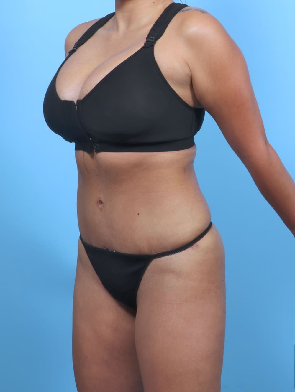 Liposuction case #5349 after, image 2