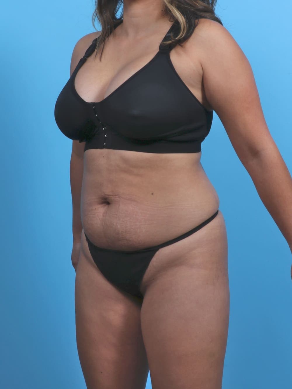 Liposuction case #5349 before, image 2