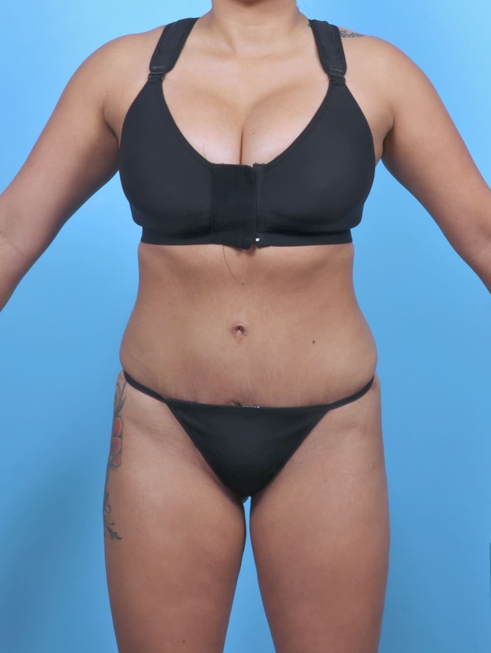 Liposuction case #5349 after