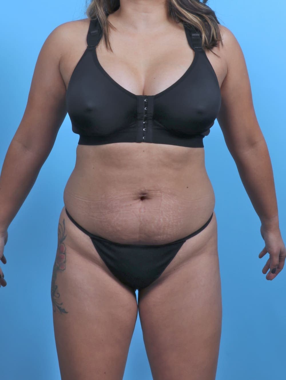 Liposuction case #5349 before