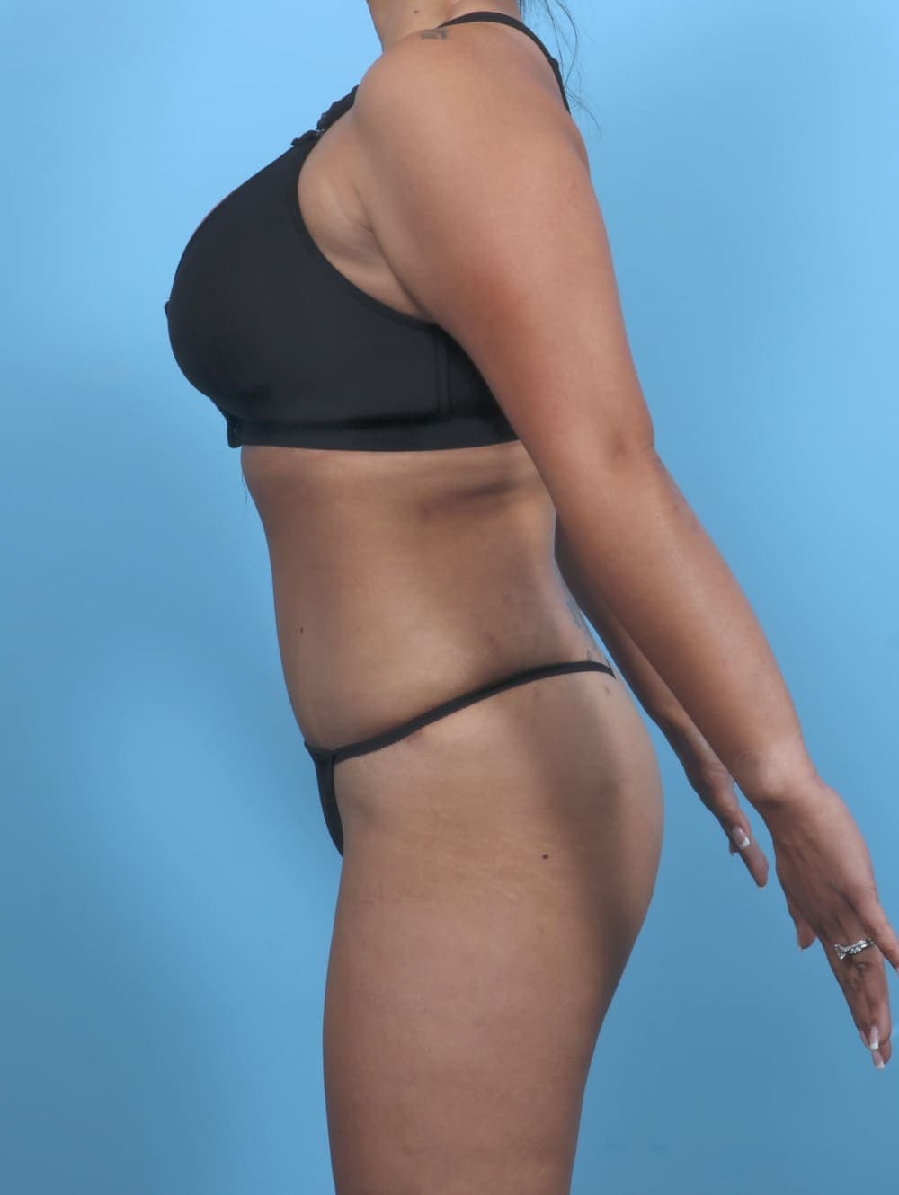 Liposuction case #5349 after, image 4