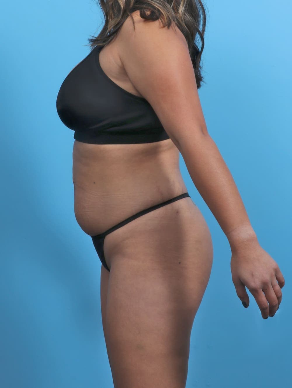 Liposuction case #5349 before, image 4