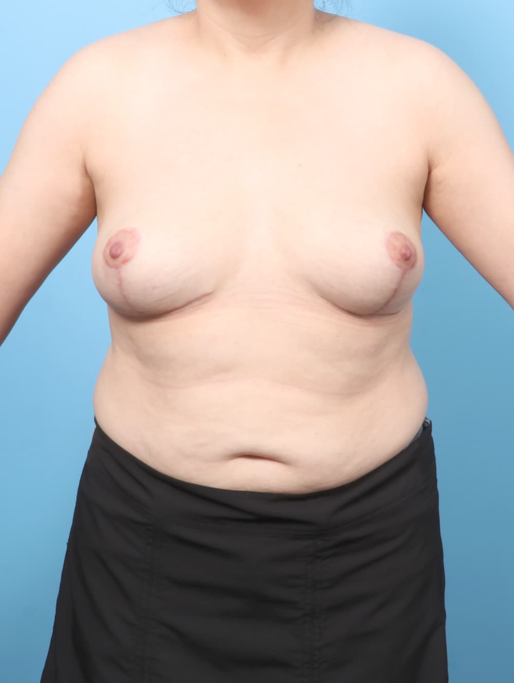 Breast Implant Removal with Lift case #8814 after, image 1