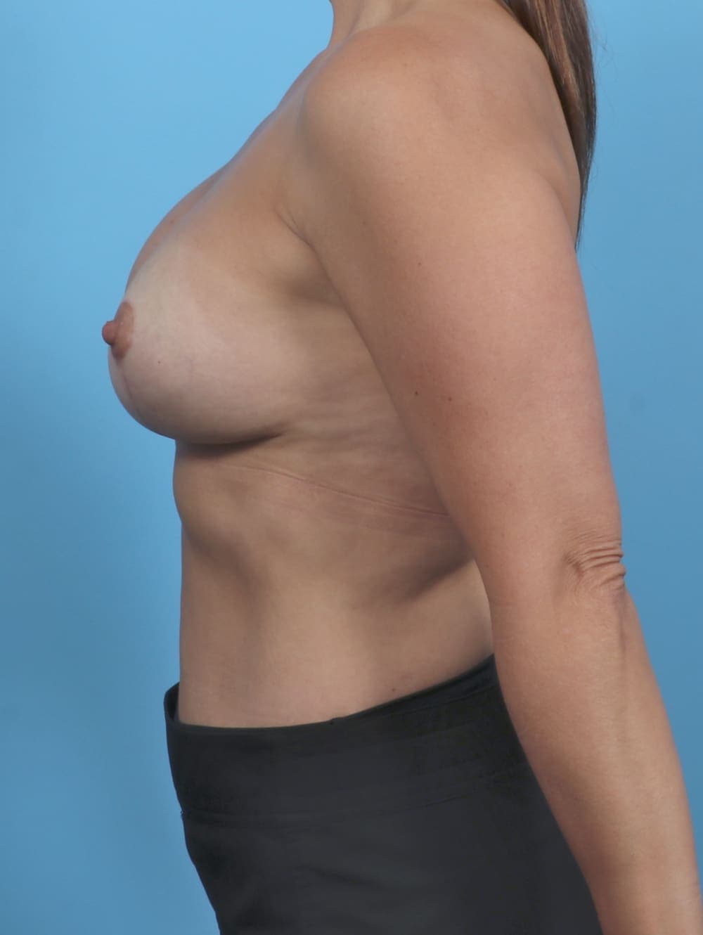 Breast Lift with Implants case #5012 after, image 3