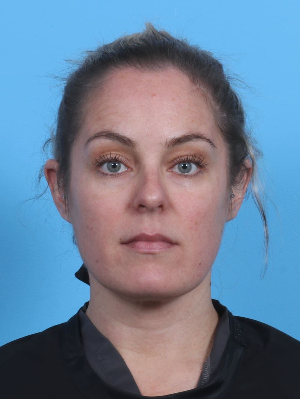 Facial Surgery case #3975 after