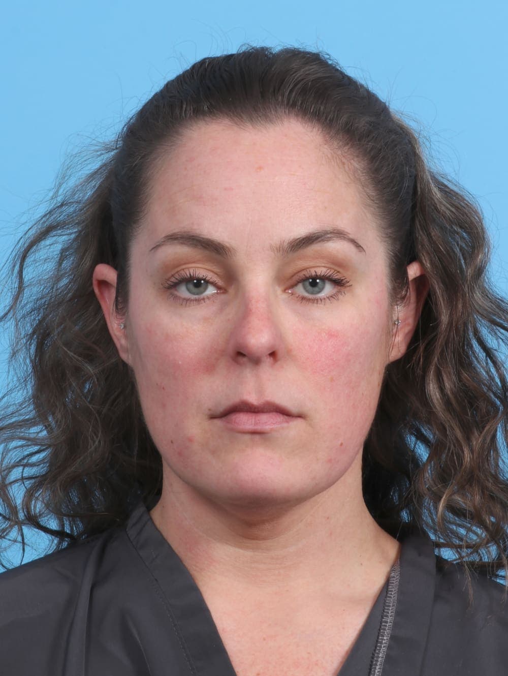 Facial Surgery case #3975 before