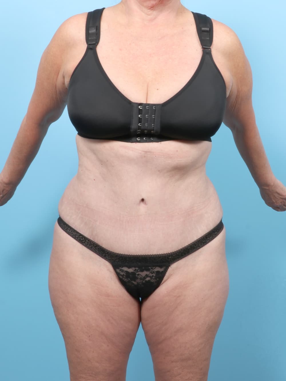 Tummy Tuck case #7461 after