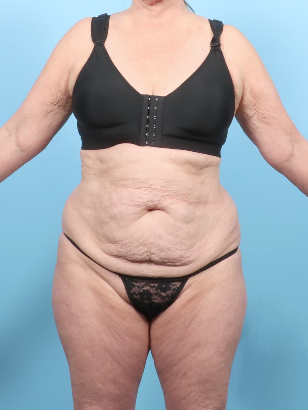 Tummy Tuck case #7461 before