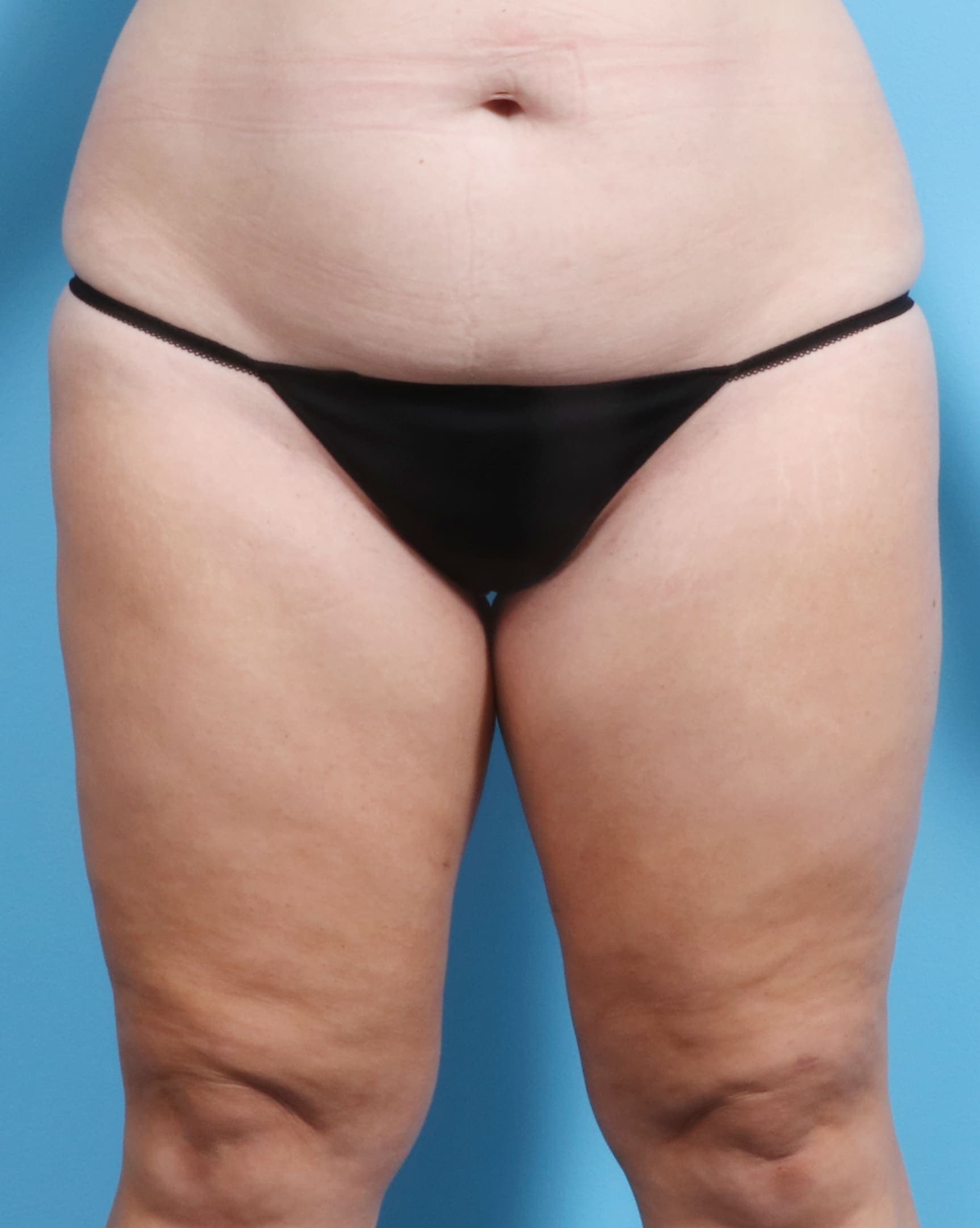 Liposuction case #1257 after, image 1