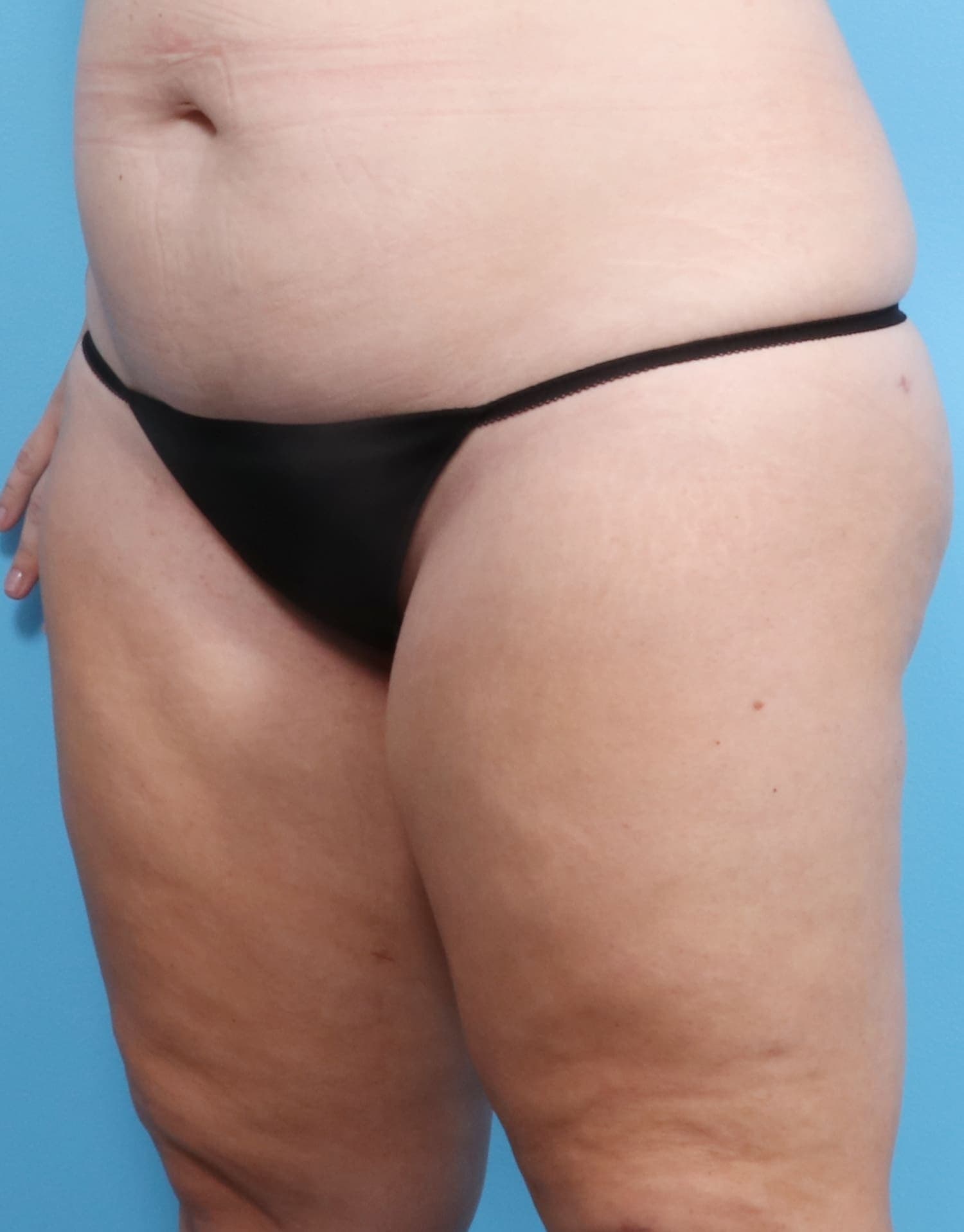 Liposuction case #1257 after, image 2
