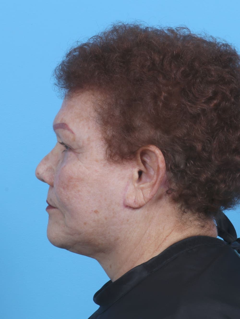 Eyelid Surgery case #3898 after, image 3