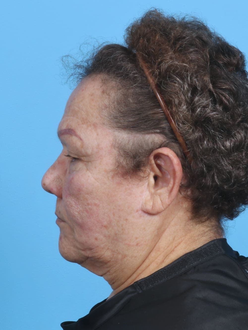Eyelid Surgery case #3898 before, image 3