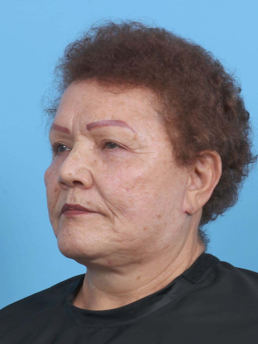 Eyelid Surgery case #3898 after, image 2