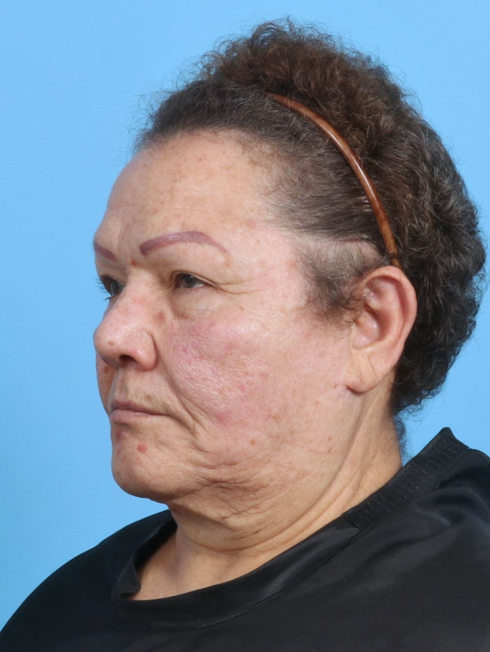 Eyelid Surgery case #3898 before, image 2