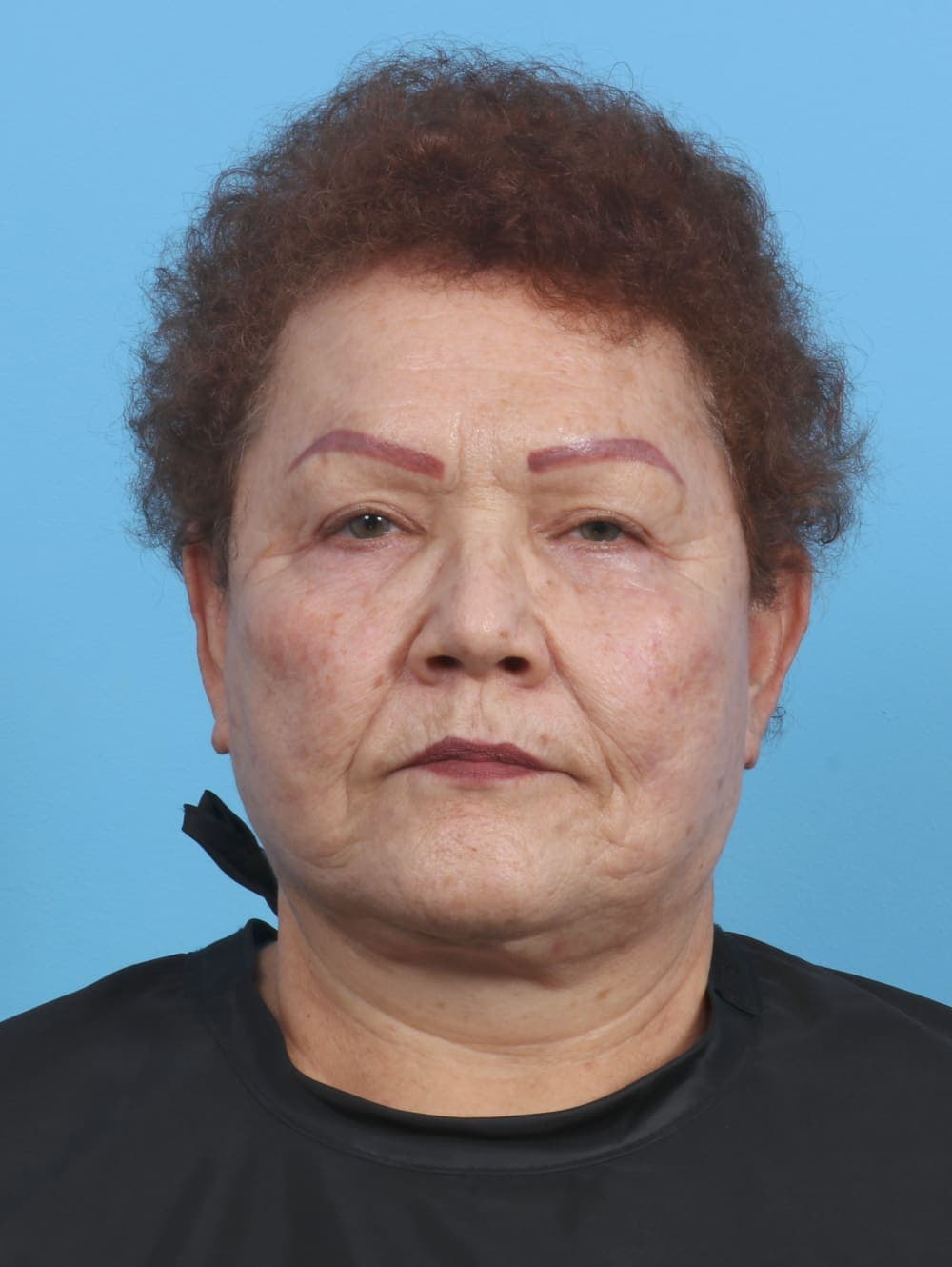 Eyelid Surgery case #3898 after