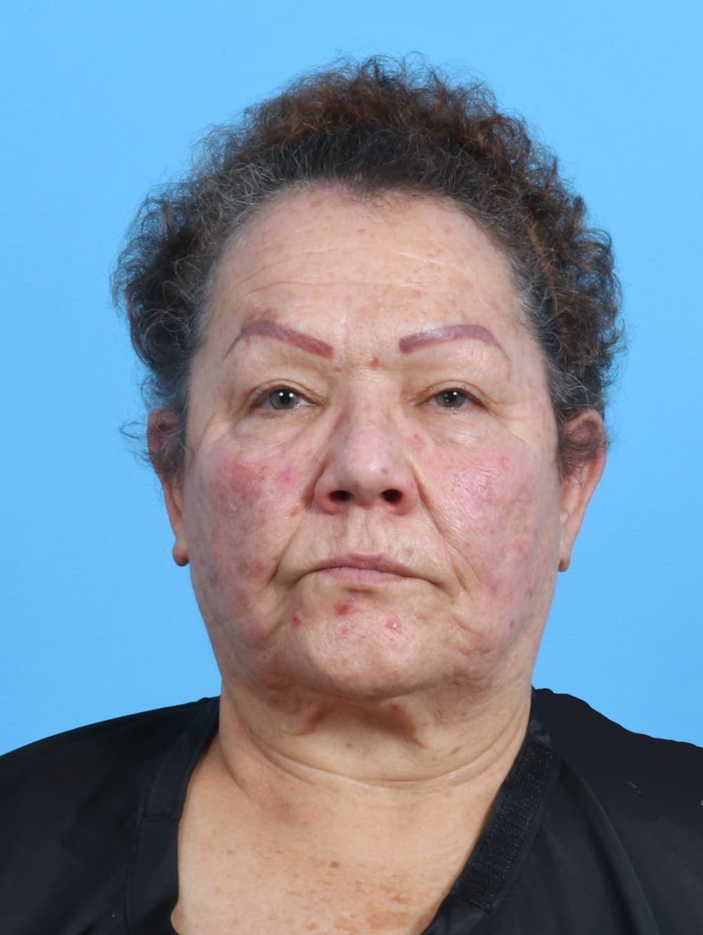 Eyelid Surgery case #3898 before