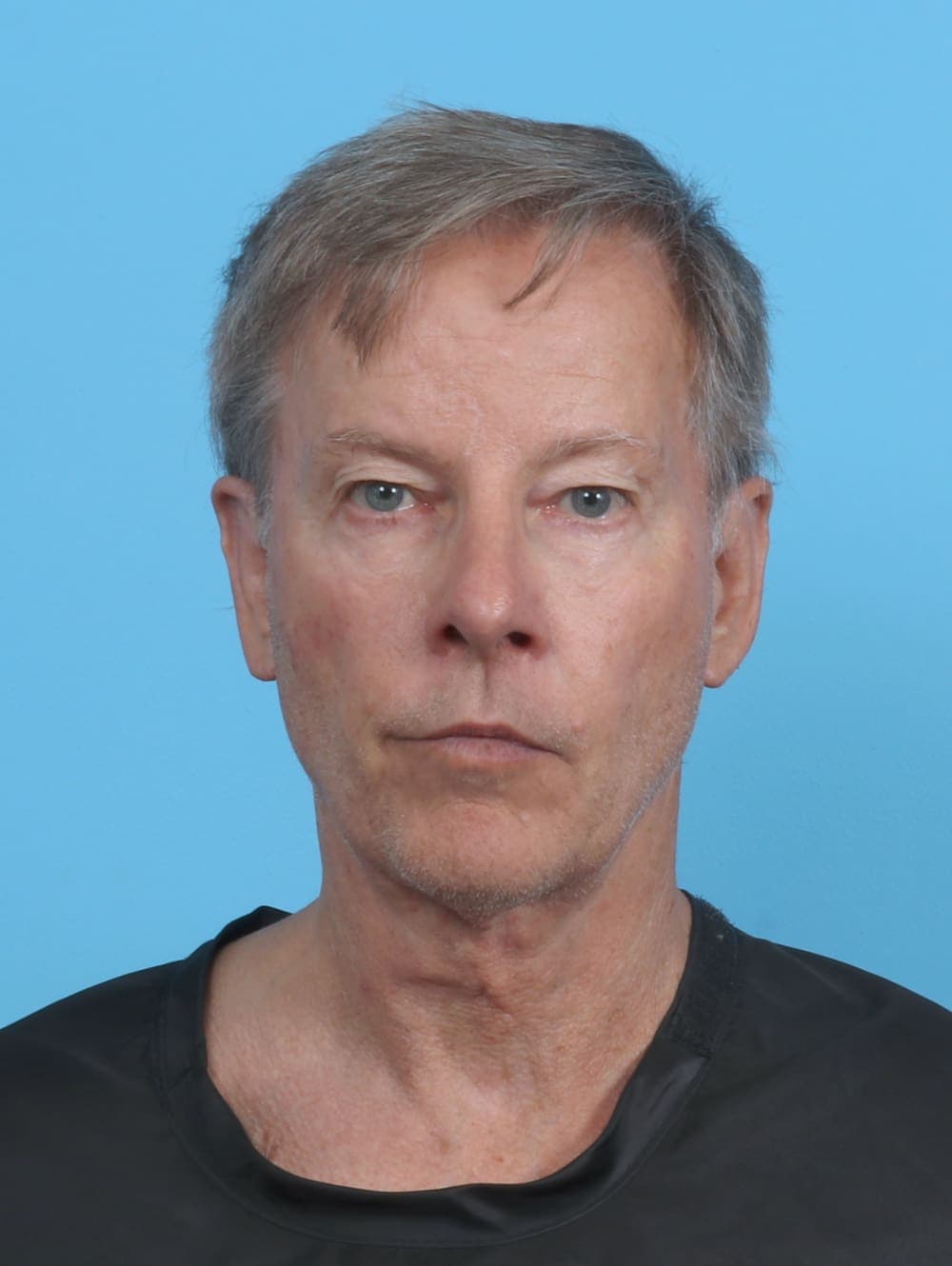 Facial Surgery case #4432 after