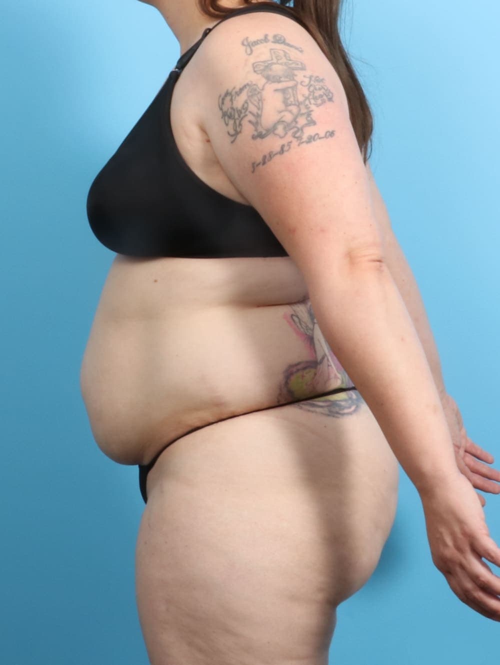 Liposuction case #2187 before, image 3