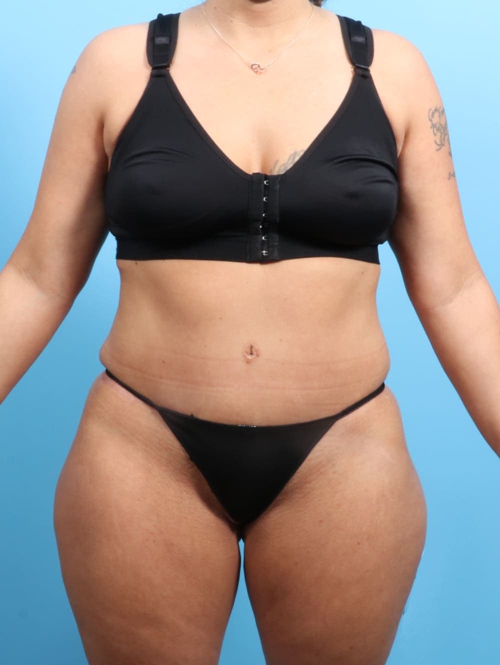 Liposuction case #2187 after