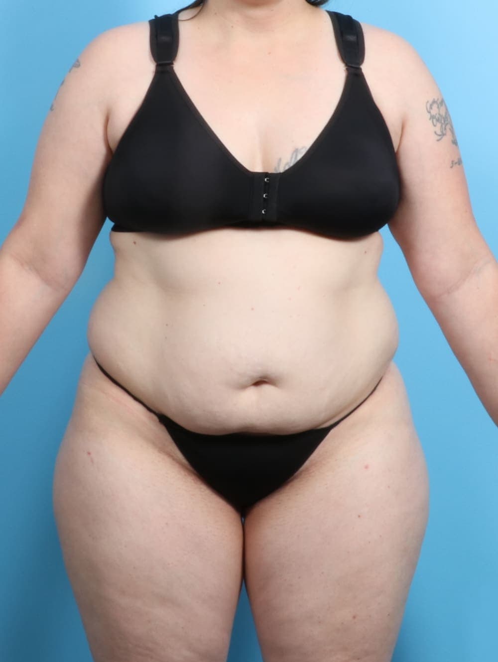 Liposuction case #2187 before