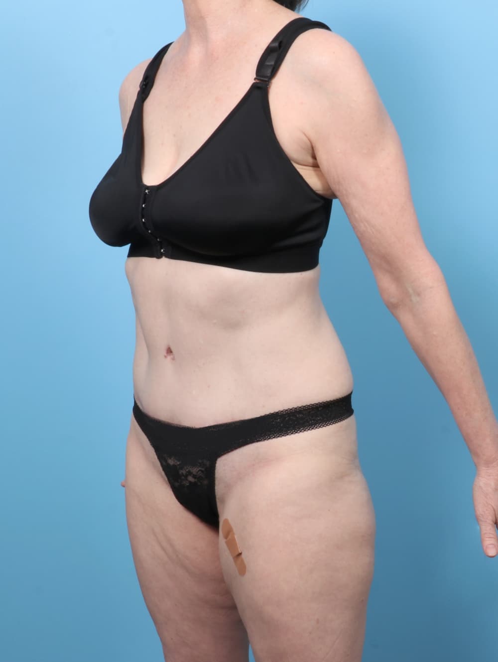 Tummy Tuck case #8352 after, image 2