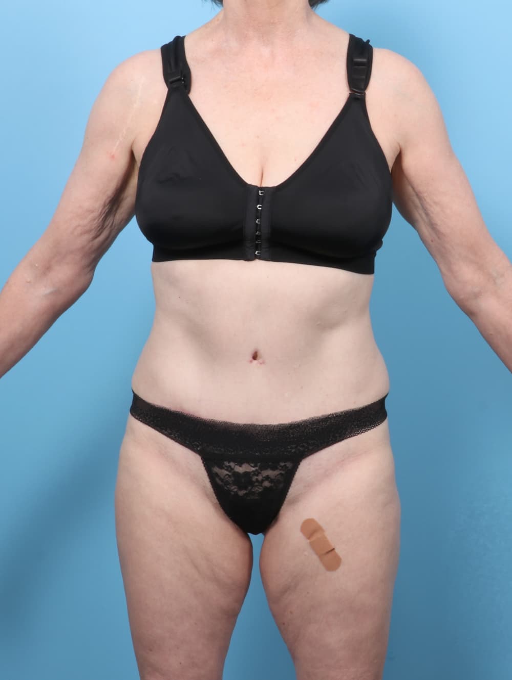 Body Contouring case #8352 after