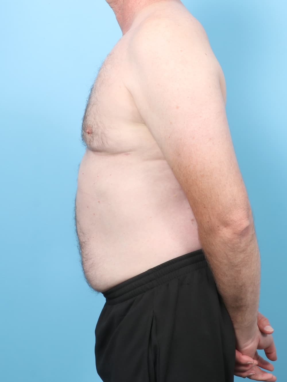 Male Breast Reduction case #8006 after, image 3