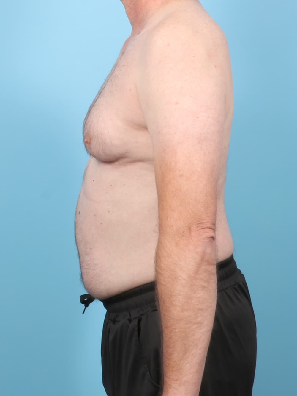 Male Breast Reduction case #8006 before, image 3