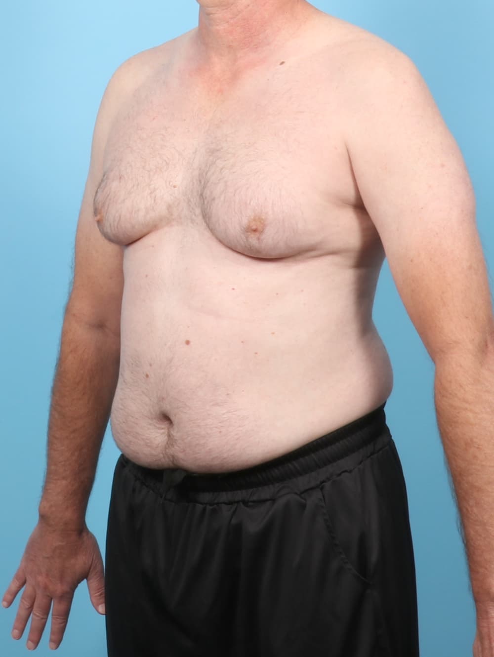 Male Breast Reduction case #8006 before, image 2