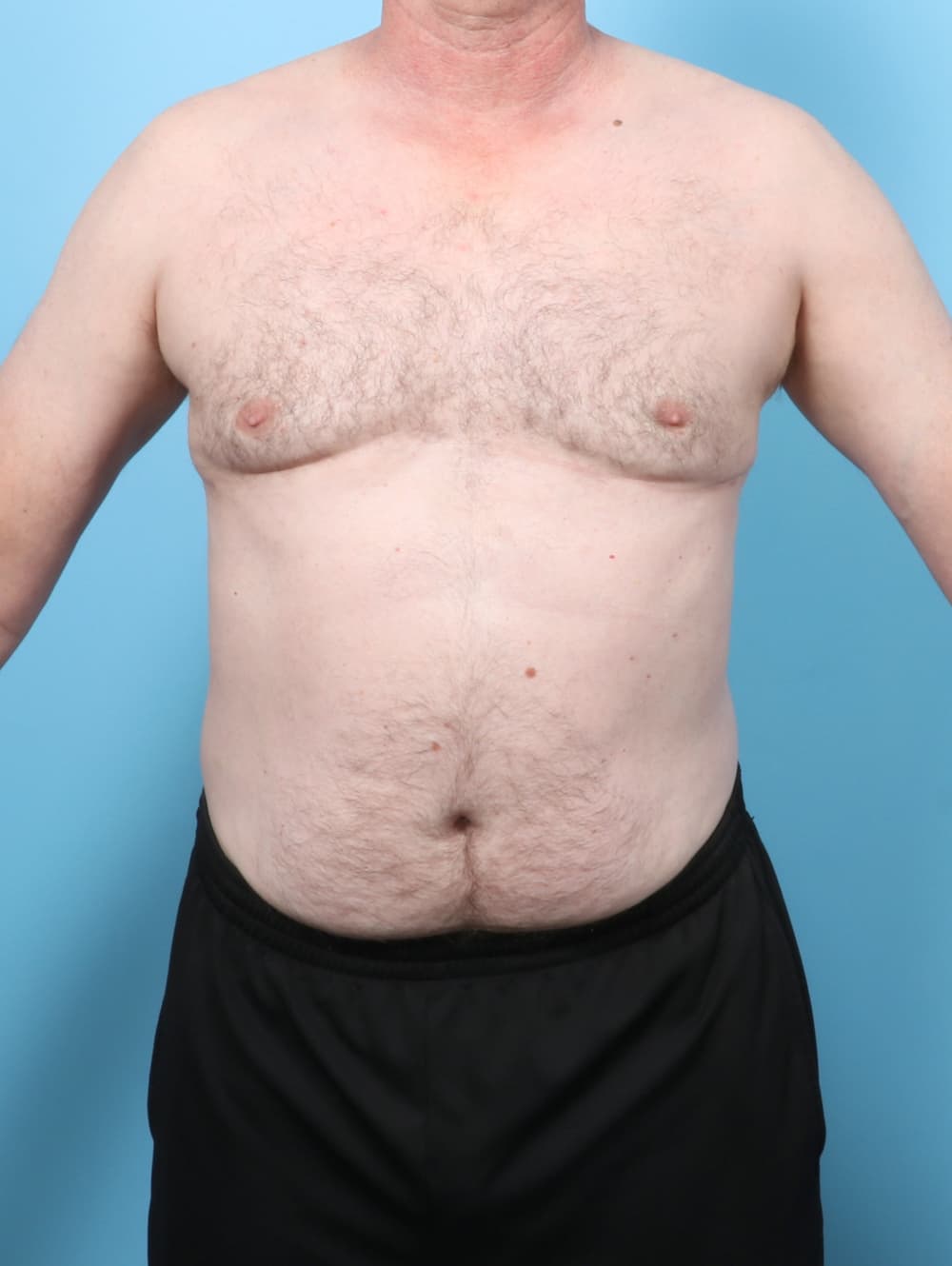 Body Contouring case #8006 after