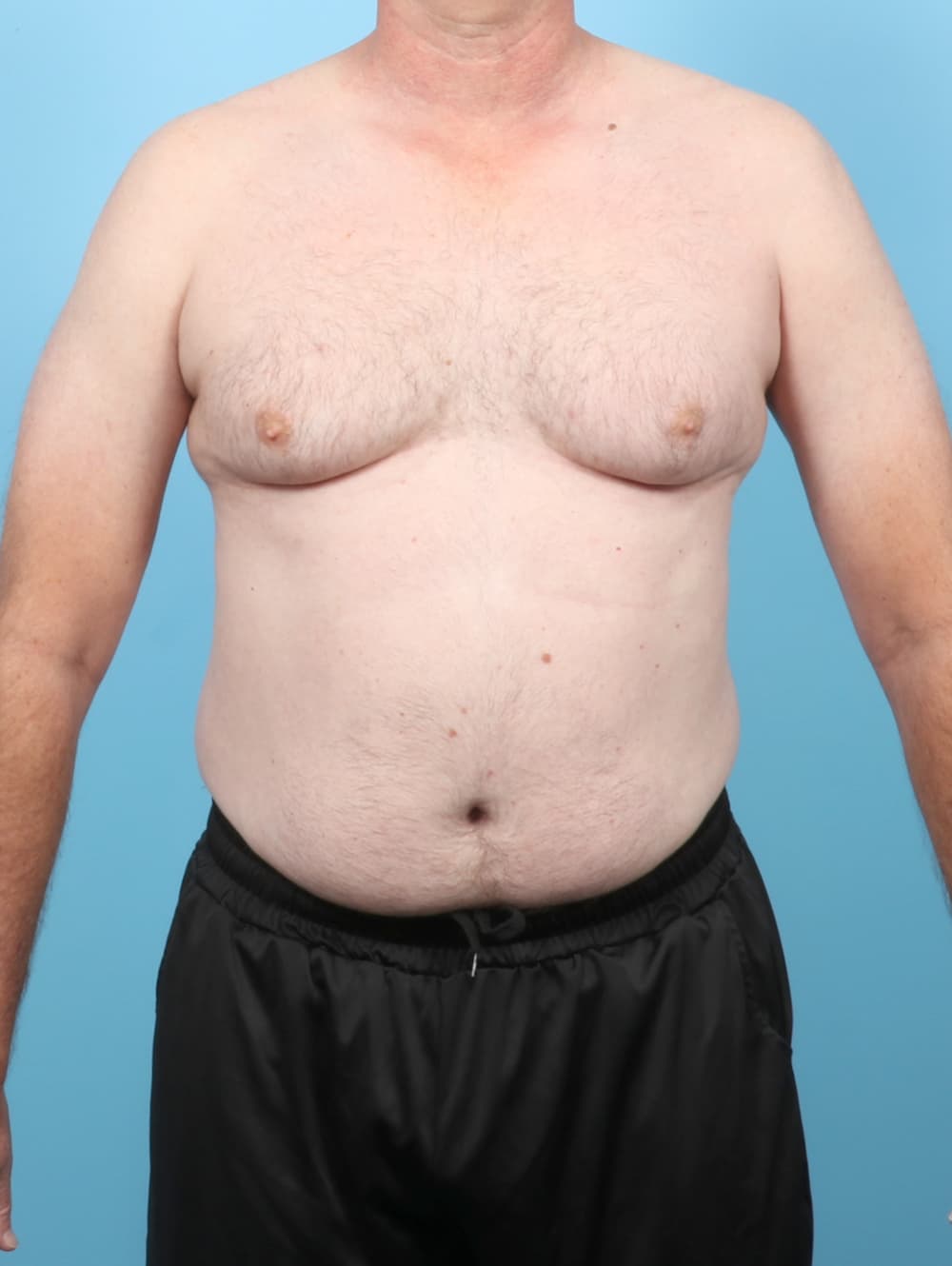 Body Contouring case #8006 before