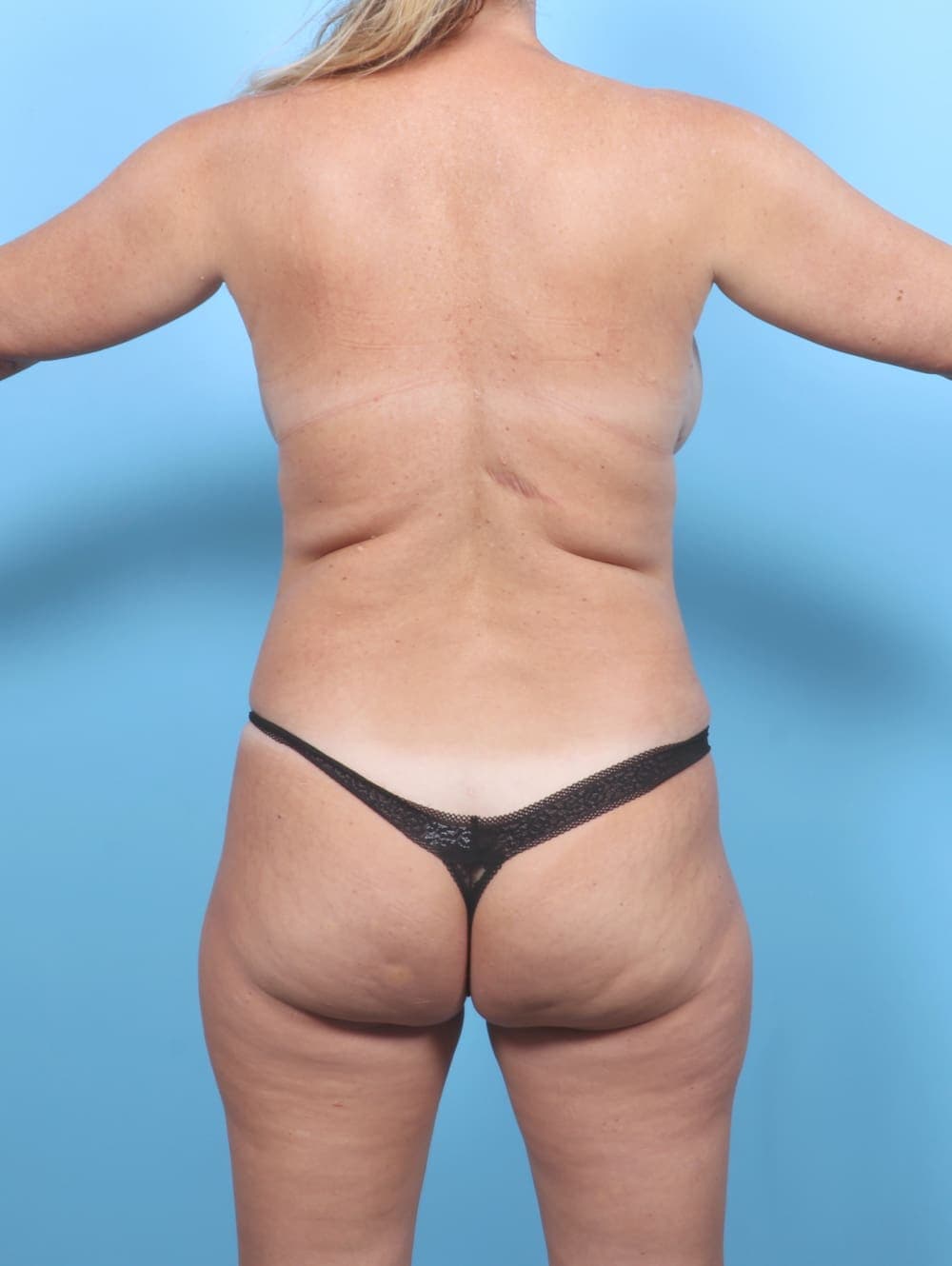 Breast Lift with Implants case #6625 after, image 4