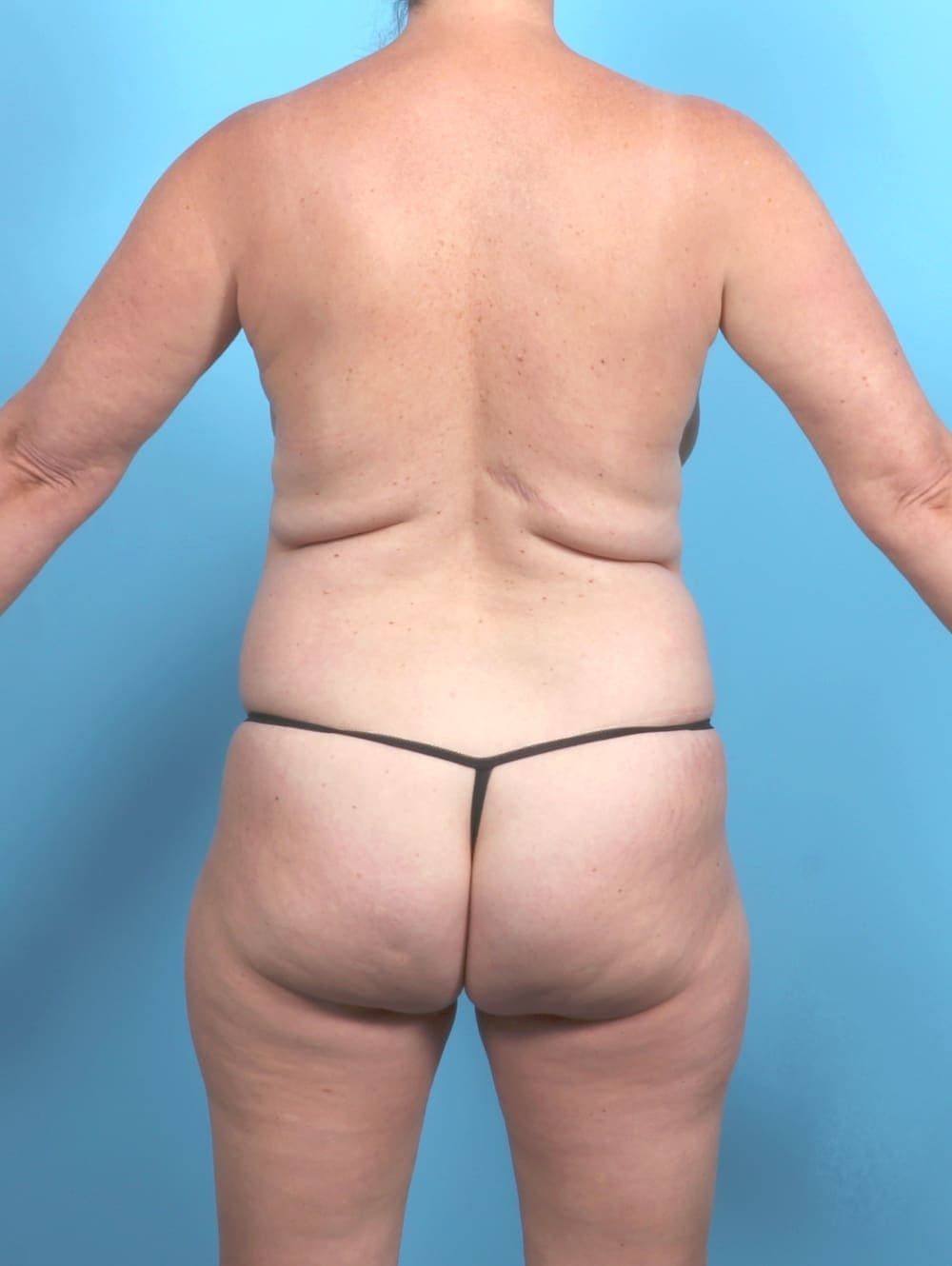Breast Lift with Implants case #6625 before, image 4