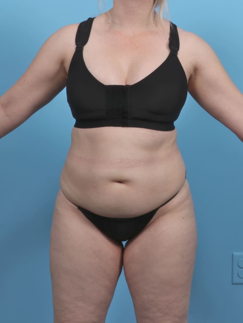 Liposuction case #5514 after