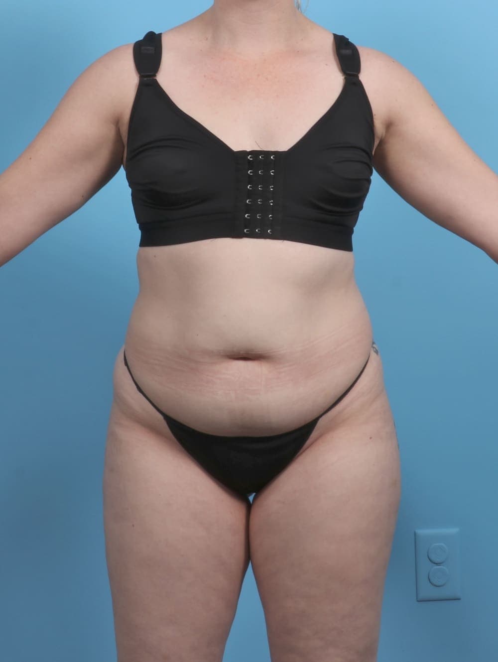 Liposuction case #5514 before