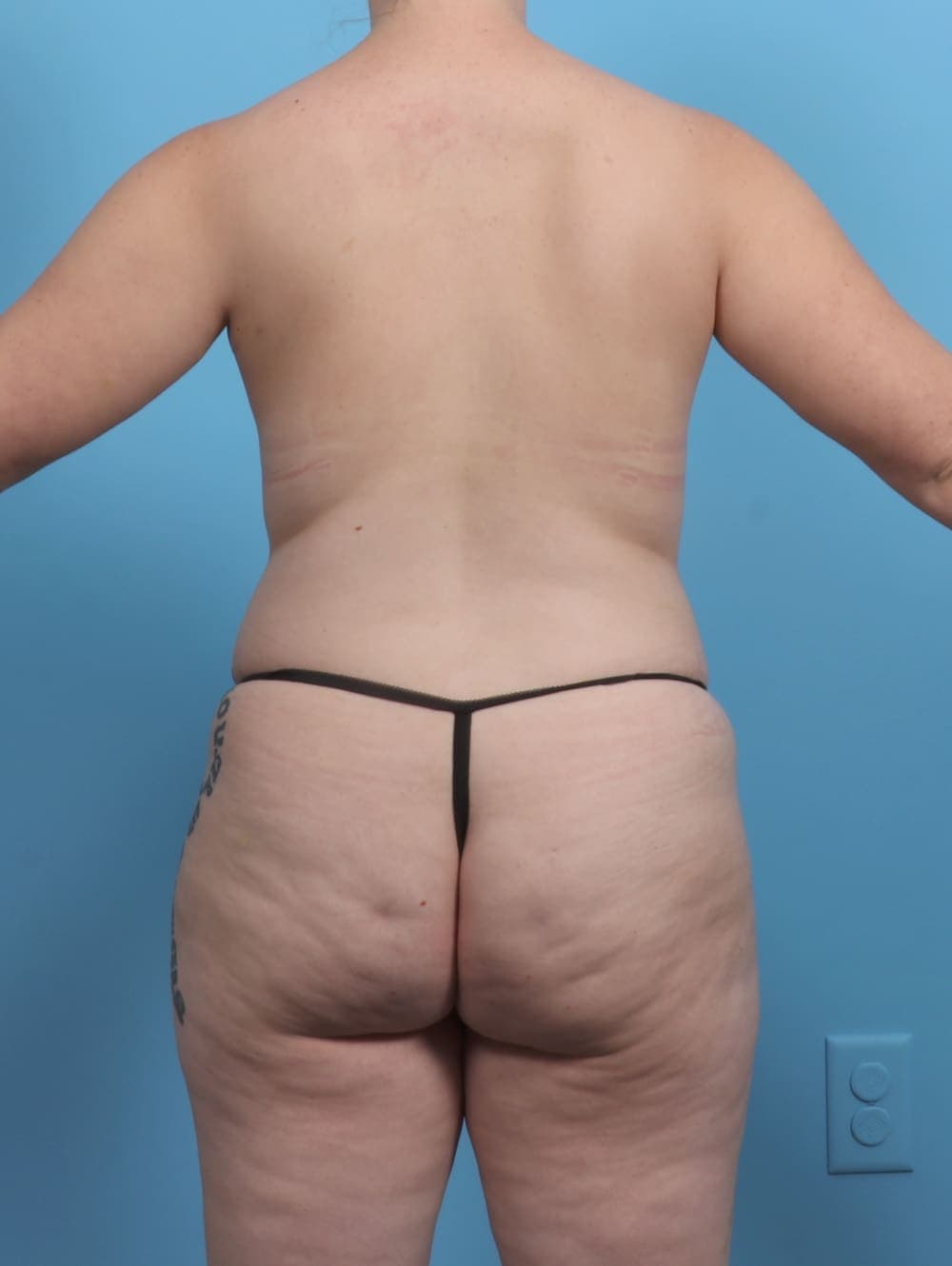 Liposuction case #5514 before, image 2