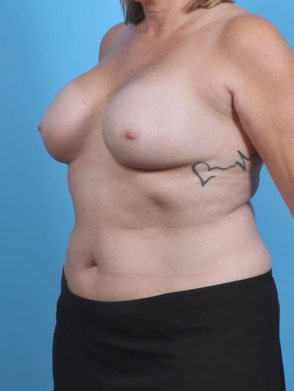 Breast Implant Revision case #4321 before, image 2