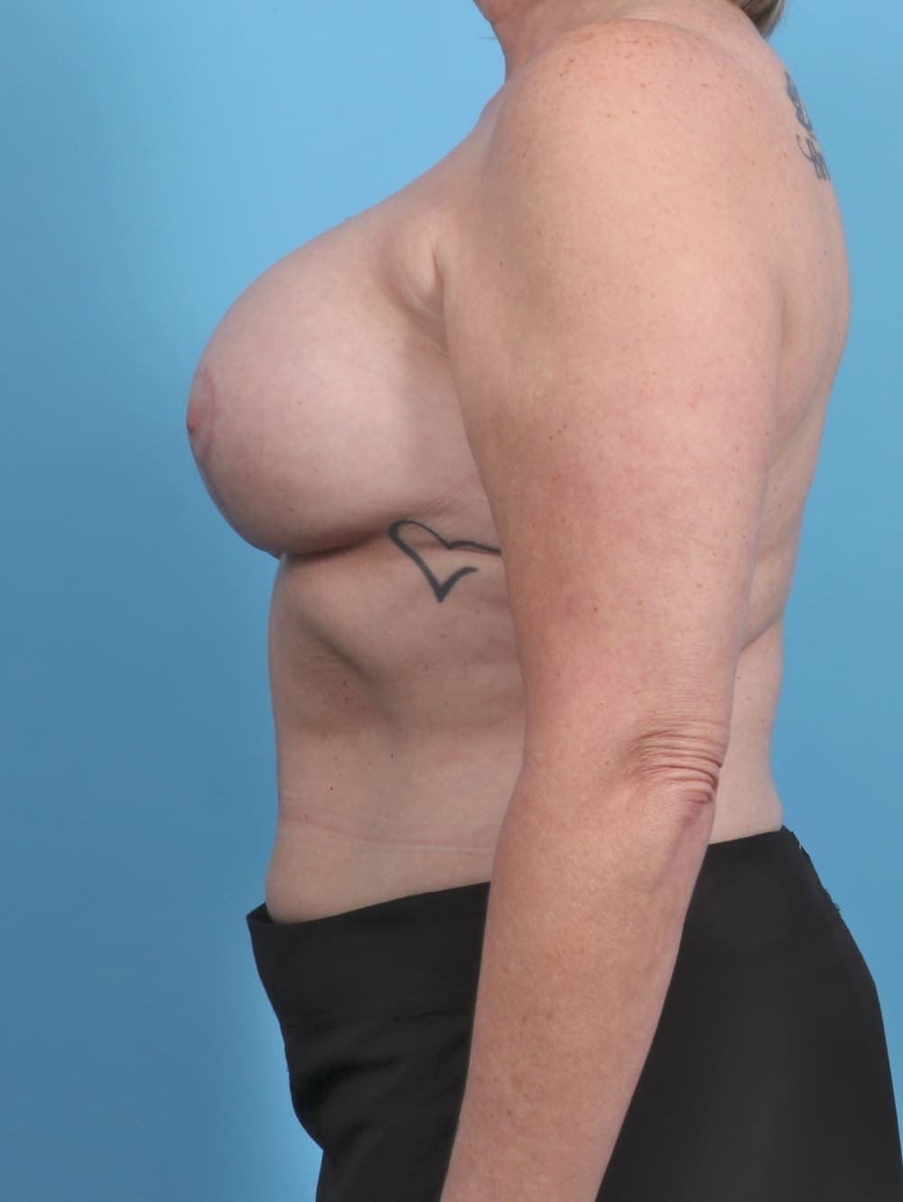 Breast Implant Revision case #4321 after, image 3
